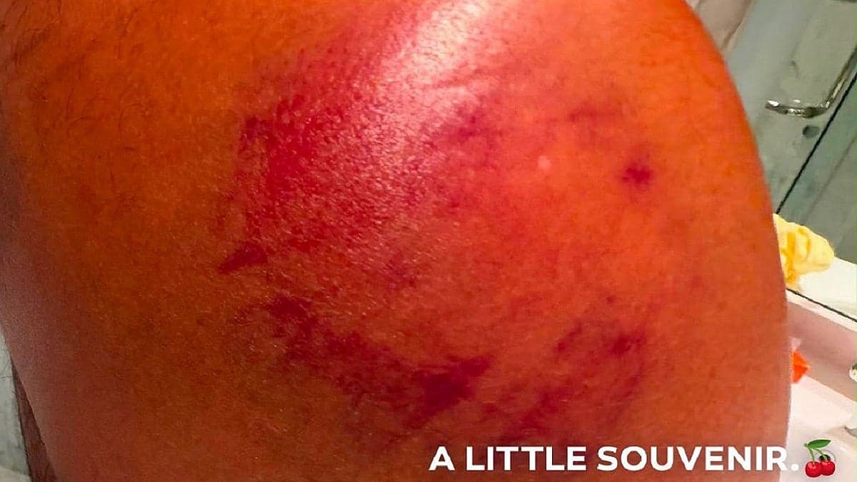 Battle Scars: Rishabh Pant Flaunts Bruised Shoulder as Match 'Souvenir'
