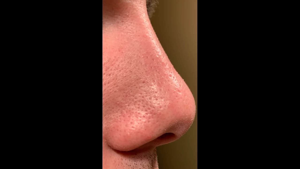 Blackheads: ಮುಖದ ಮೇಲಿನ ಕಪ್ಪು ಚುಕ್ಕೆ ತೆಗೆಯಲು ಈ ಮನೆಮದ್ದು ಬಳಸಿ ಸಾಕು!