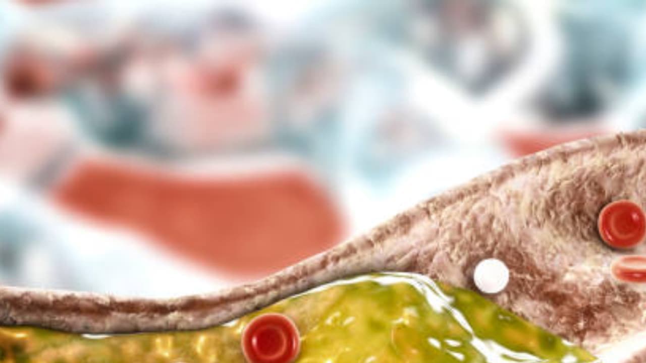 Foods That Dangerously Spike Your LDL Cholesterol Levels