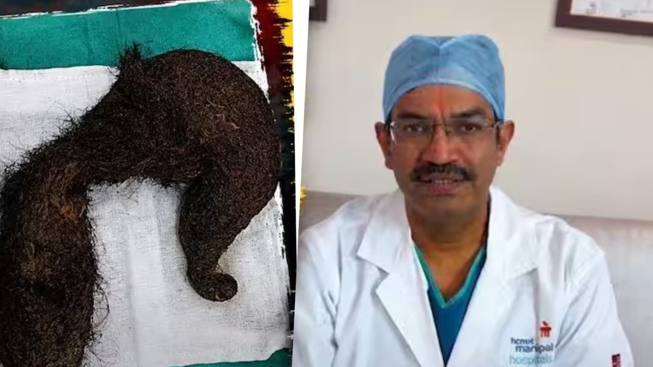 20 ವರ್ಷದ ಯುವತಿ ಹೊಟ್ಟೆಯಲ್ಲಿ 1.16 ಕೆಜಿ ಕೂದಲು; 11 ವರ್ಷಗಳಿಂದ ತನ್ನ ಕೂದಲನ್ನೇ ತಿನ್ನುತ್ತಿದ್ದ ಹುಡುಗಿ